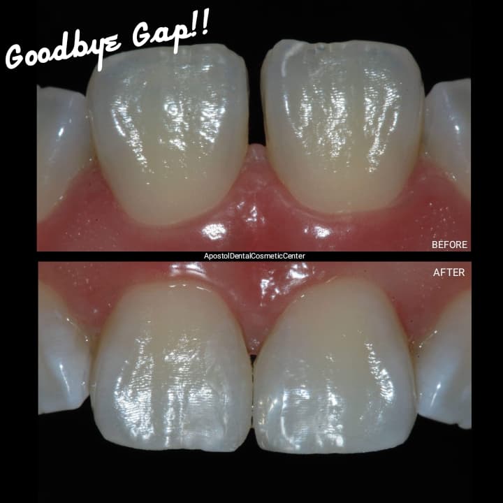 SAY GOODBYE TO TEETH GAPS AND MINOR CRACKS