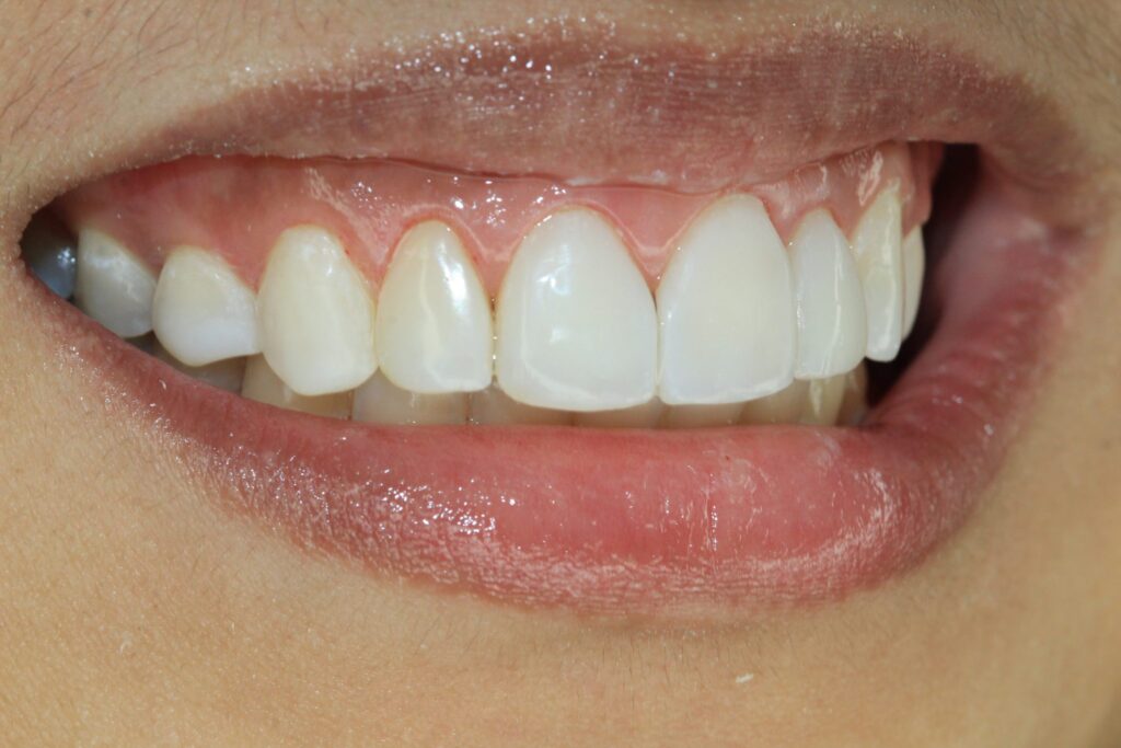 Renew your smile and overall dental health