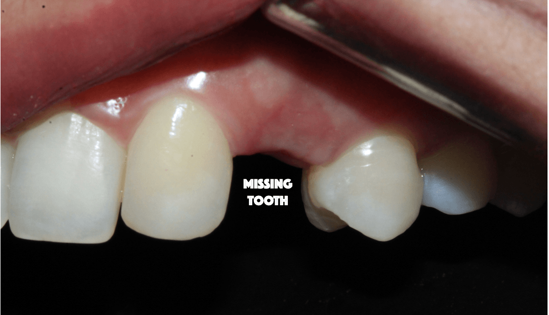 MISSING TEETH? WHAT’S THE BEST OPTION?