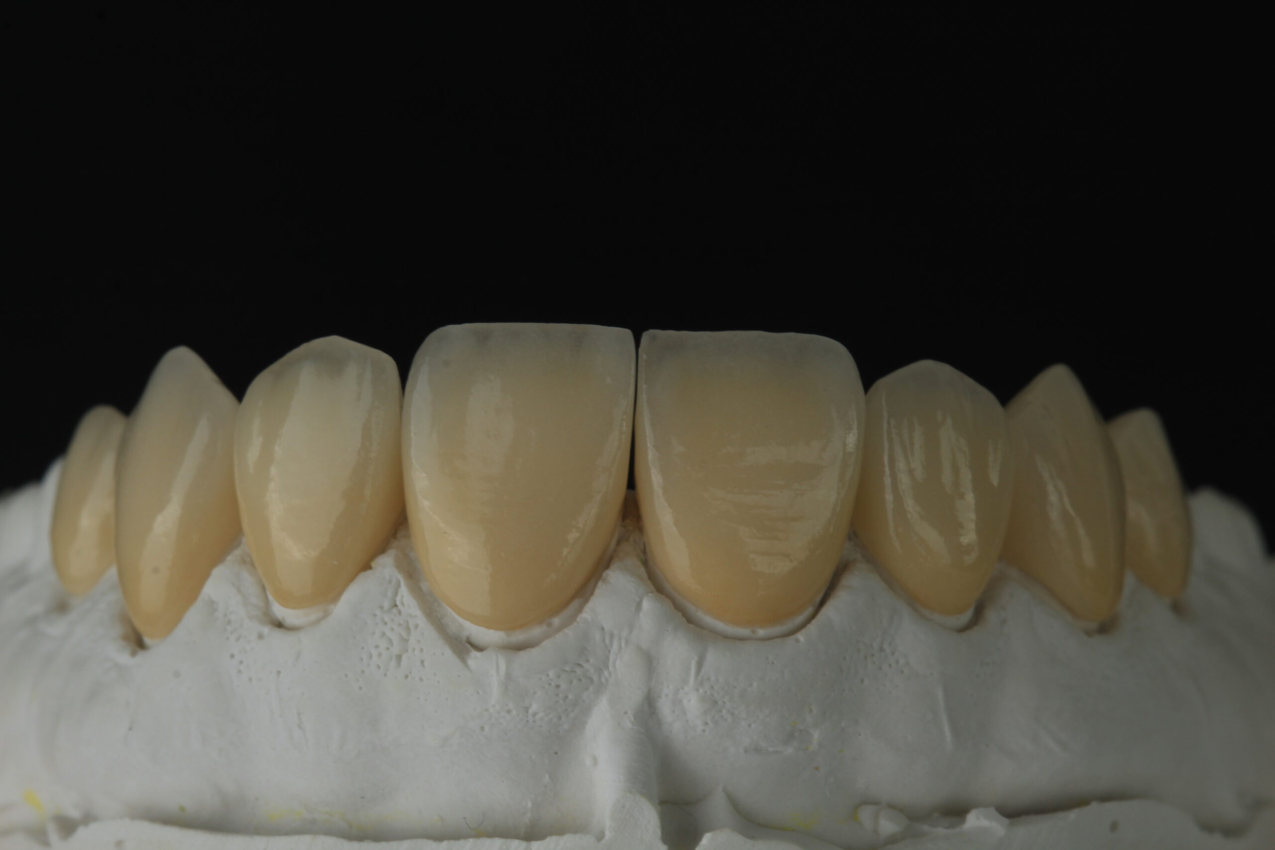 Dental veneers sample