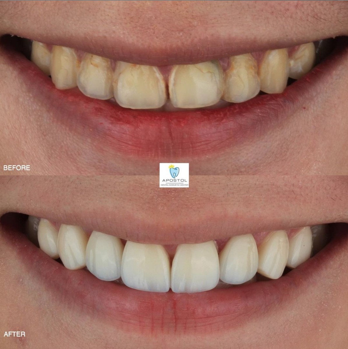 Restorative cosmetic dentistry before and after