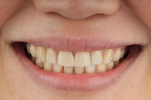 After direct composite dental veneers photo#1