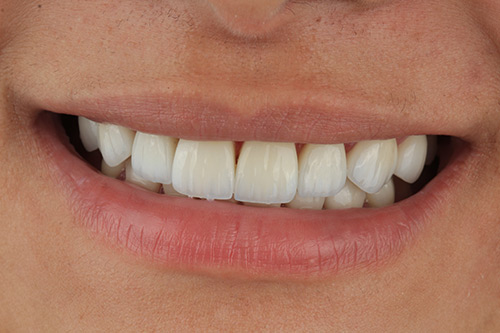 After zirconia dental veneers photo#1