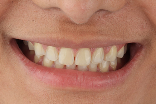 Before zirconia dental veneers photo#1