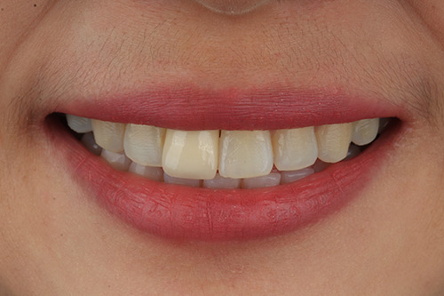 Before zirconia dental veneers photo#2
