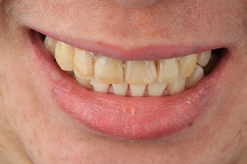 Before zirconia dental veneers photo#3