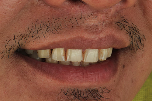 After zirconia dental veneers photo#5