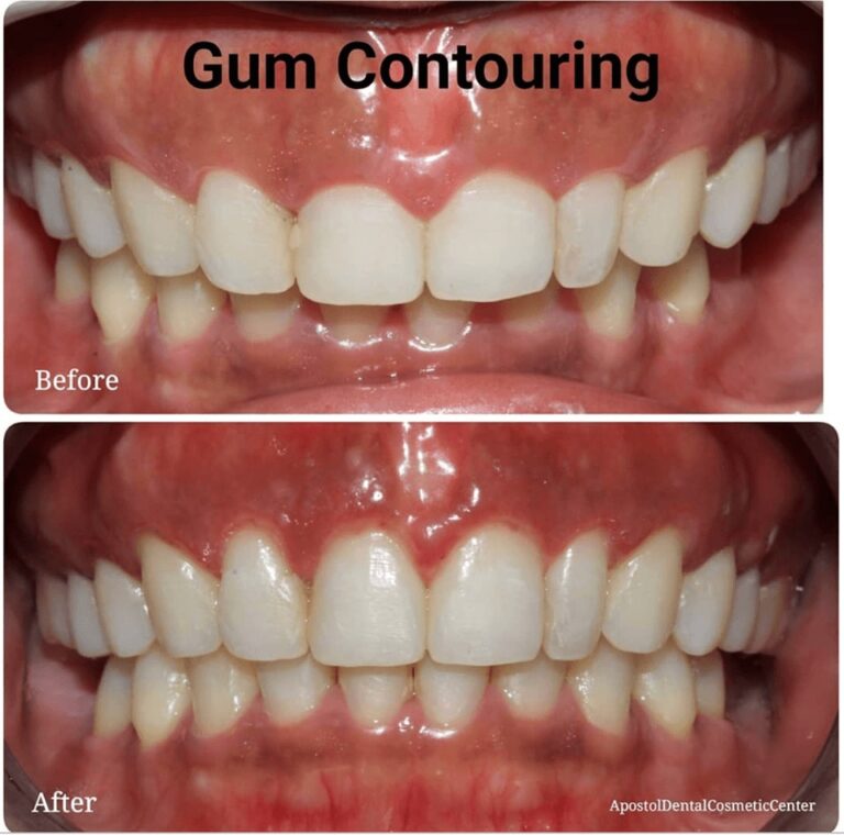 Gum Contouring & Reshaping | Apostol Dental Cosmetic Center