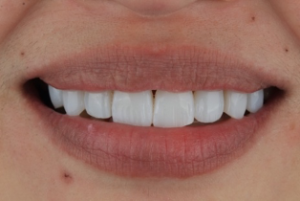 Direct Composite Veneers 1 - Apostol Dental Cosmetic Center