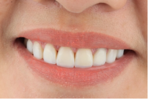 Direct Composite Veneers 2 - Apostol Dental Cosmetic Center