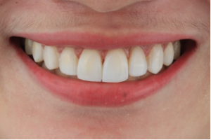 Direct Composite Veneers - Apostol Dental Cosmetic Center