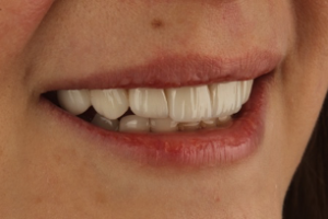 Emax Porcelain Veneers 1 - Apostol Dental Cosmetic Center