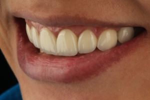 Emax Porcelain Veneers 3 - Apostol Dental Cosmetic Center