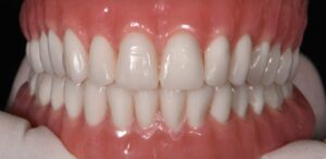 Sample Removable Complete Denture - Apostol Dental Cosmetic Center