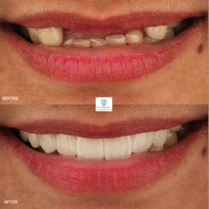 Sample Zirconia fixed bridge before and after- Apostol Dental Cosmetic Center