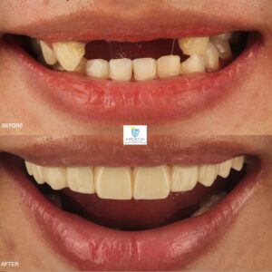 Sample Zirconia fixed bridge before and after 1- Apostol Dental Cosmetic Center