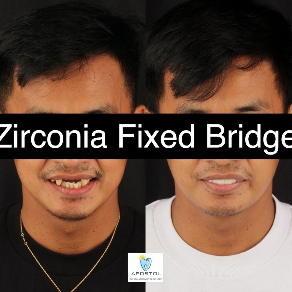 Zirconia fixed bridge before and after - Apostol Dental Cosmetic Center