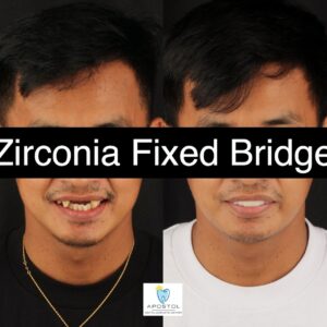Zirconia fixed bridge before and after 2 - Apostol Dental Cosmetic Center