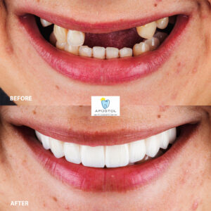 Sample Zirconia fixed bridge before and after 2- Apostol Dental Cosmetic Center