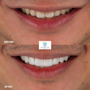 Zirconia veneers before and after sample 1 - Apostol Dental Cosmetic Center