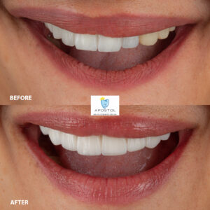 Zirconia veneers before and after sample 3 - Apostol Dental Cosmetic Center