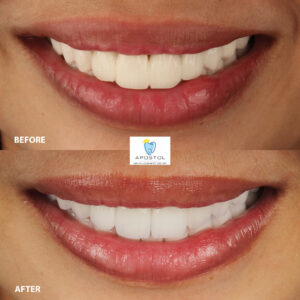 Zirconia veneers before and after sample 2 - Apostol Dental Cosmetic Center