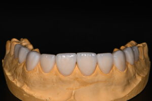 Complete process for veneers - Apostol Dental Cosmetic Center