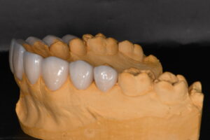 Complete process for veneers 5 - Apostol Dental Cosmetic Center