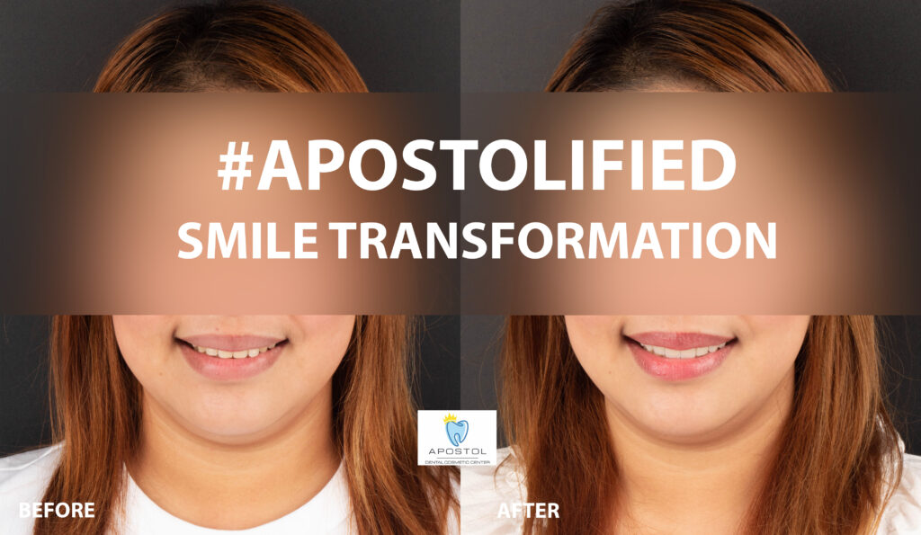 Smile transformation - Apostol Dental Cosmetic Center