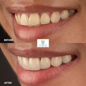 Cosmetic Dentistry before and after 2 | Apostol Dental Cosmetic Center