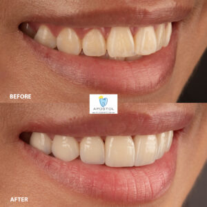 Cosmetic Dentistry before and after | Apostol Dental Cosmetic Center