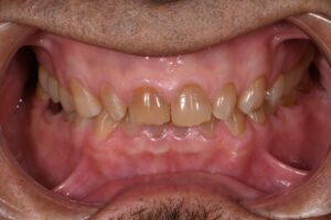 Dental bruxism | Apostol Dental Cosmetic Center