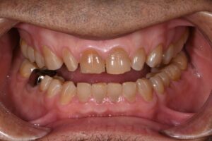 Effects of bruxism | Apostol Dental Cosmetic Center