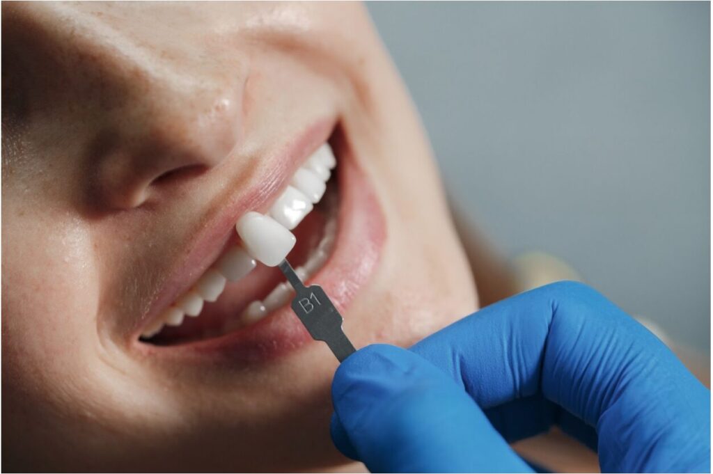 Dental Crowns guide | Apostol Dental Cosmetic Center