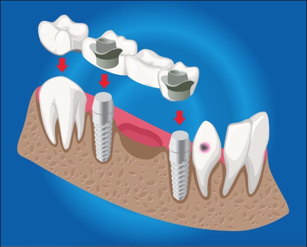 Dental Implants | Apostol Dental Cosmetic Center