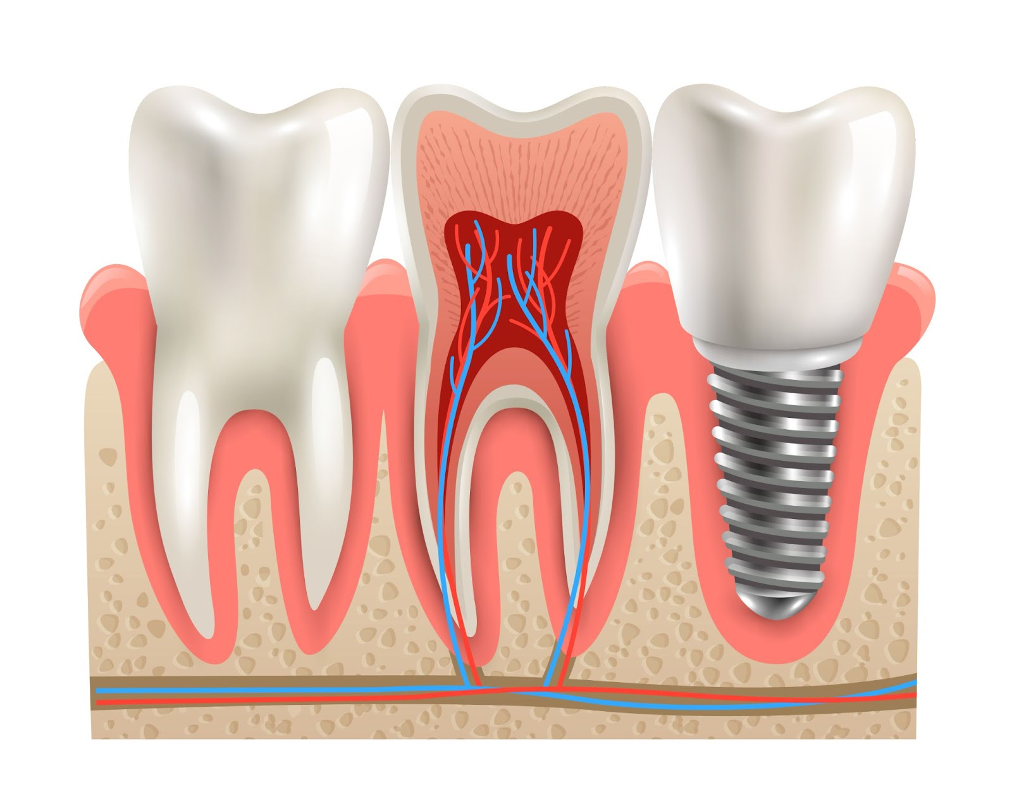 How to Choose Between Dental Implants and Bridges