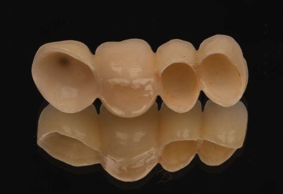 Dental crown
