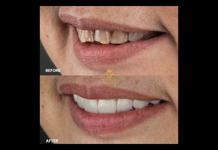 Dental Crown Philippines