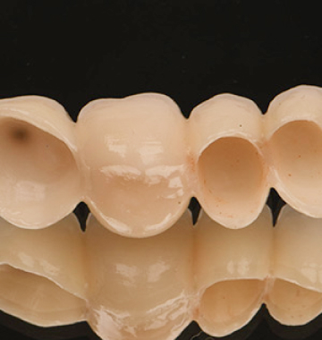 Ceramic Crown vs Porcelain Crown: What’s the Difference?