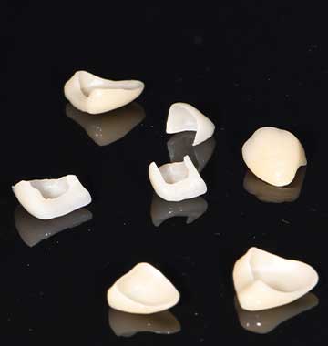Dental Veneers