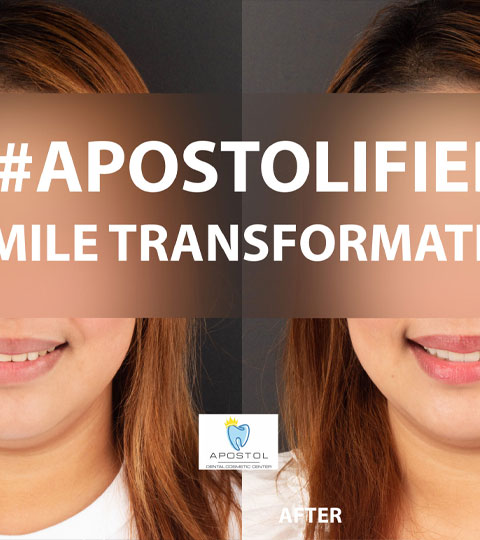 How Long does it take to Complete the Process for Veneers?