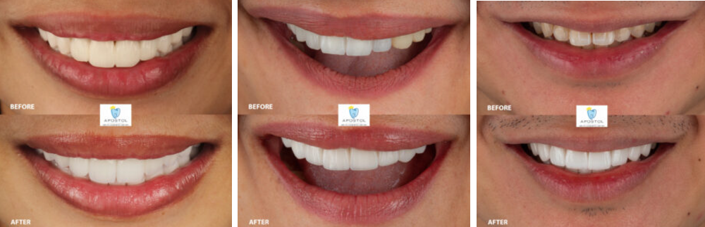 Smile Makeover: Is It Worth It?