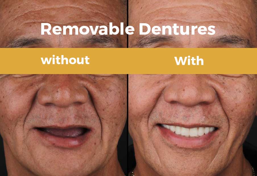 Complete denture