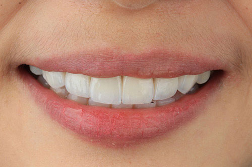 What Makes Zirconia Fixed Bridges Better Than Traditional Bridges?