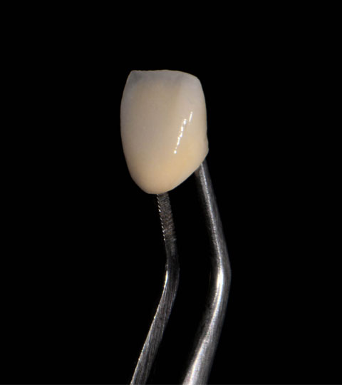 Cost of Veneers in the Philippines