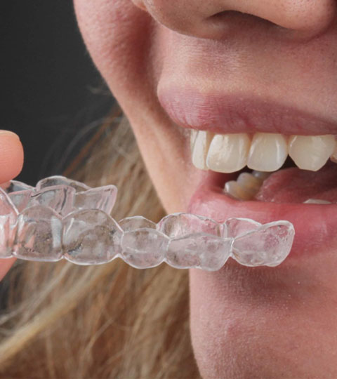 Nightguard after getting veneers, is it really required?