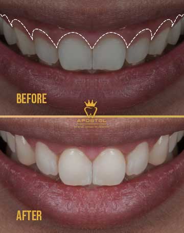 Gum Contouring & Reshaping