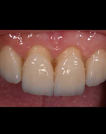 Natural Looking Veneers